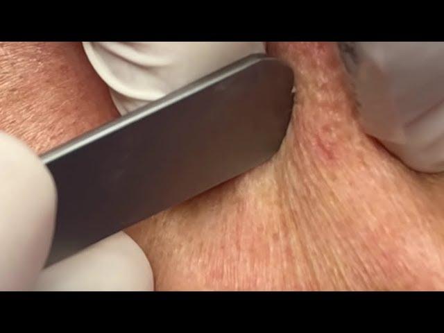 Blackhead Oozes out like toothpaste! (Ear Blackheads) - ChangYing Spa