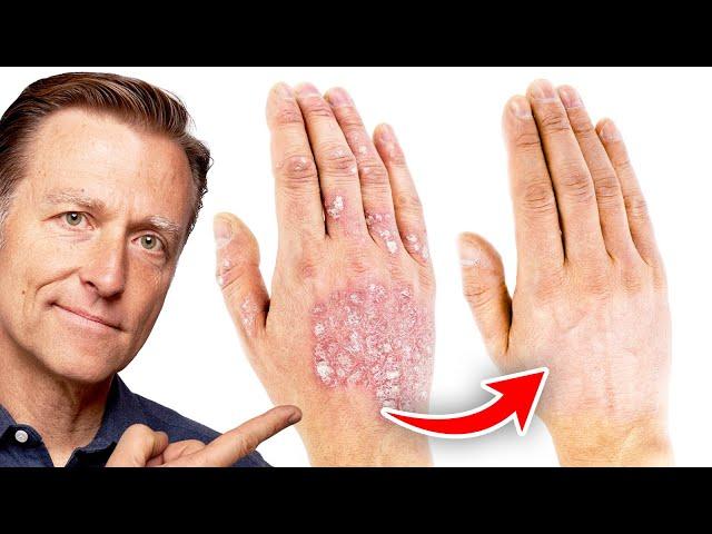 The #1 Best Remedy for Eczema