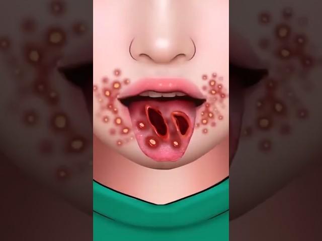 ASMR Stomatitis Treatment Because of Eating Hot Spicy #shorts