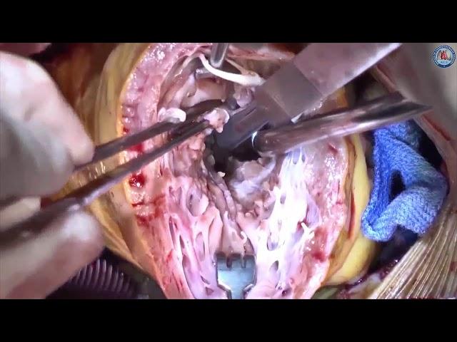 Transapical approach for myectomy in hypertrophic cardiomyopathy