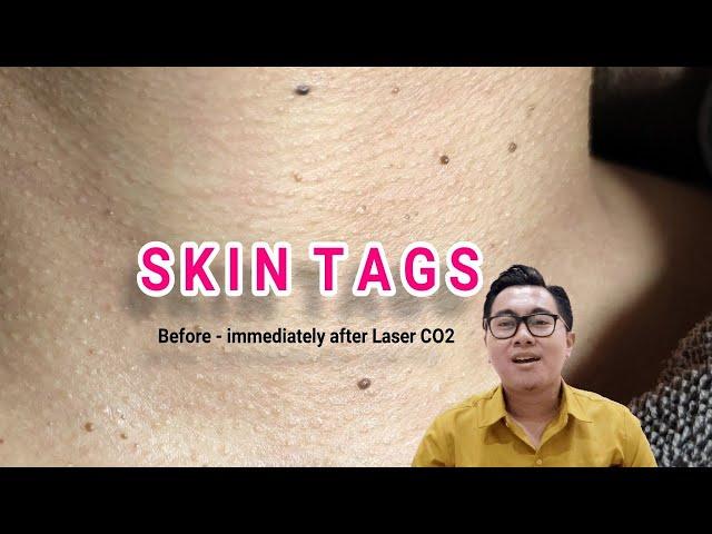 Mirip kutil-kutil di leher? Ini Skin Tags, yuk Laser CO2 aja! #laserco2 #skintags #natashaskincare