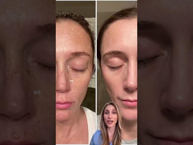 How I transformed my melasma patient's skin in 4 months!