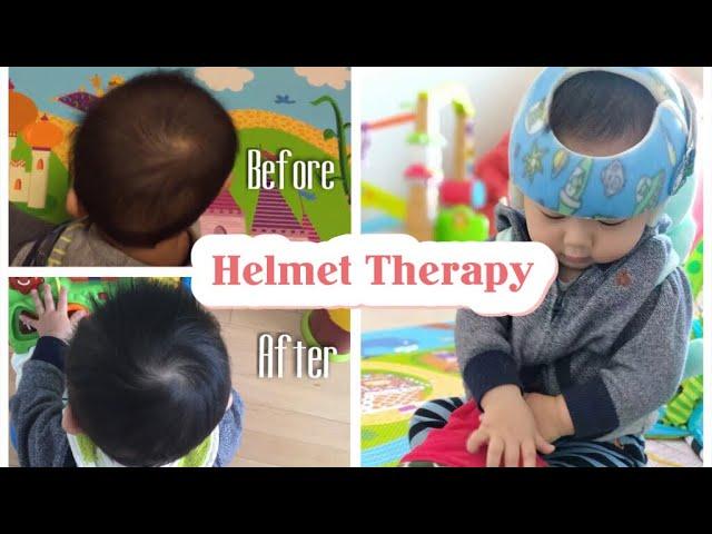 12 Weeks Progress: Helmet Therapy For Flat Head Syndrome/Plagiocephaly