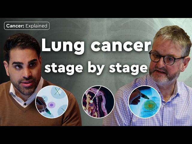 What happens in every stage of lung cancer? | Cancer: Explained | Macmillan Cancer Support