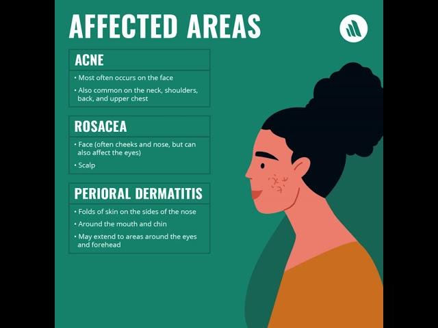 Comparing Skin Issues: Acne vs. Rosacea vs. Dermatitis | Merck Manual