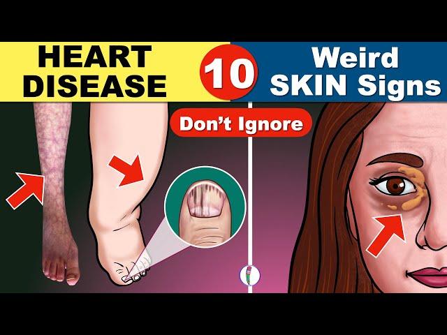 10 Skin Signs of Heart Disease | Coronary Artery Disease | Heart Failure | Heart Attack