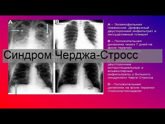 Синдром Черджа-Стросс