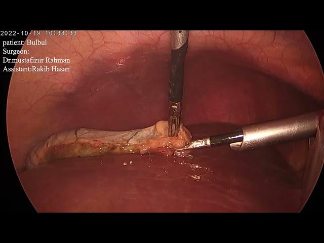 laparoscopic cholecystectomy | Dr.Mustafizur Rahman