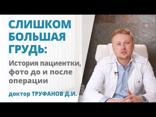 Уменьшение очень большой груди: невероятный результат операции