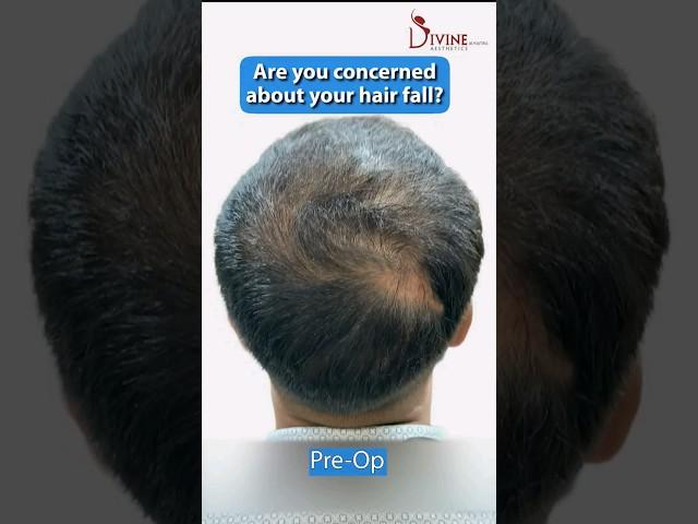 GFC for Hair Loss Treatment | Growth Factor Concentrate Therapy #gfc #shorts