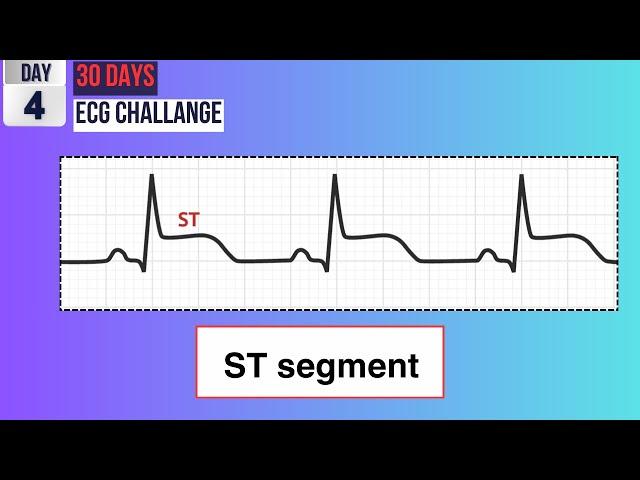 Day 4: Decoding the ST Segment | 30-Day ECG Challenge