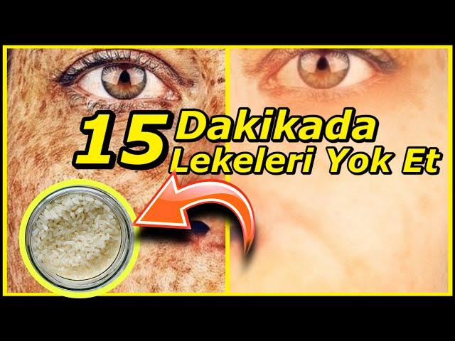 15 Dakikada CİLT LEKELERİ  Sivilce ve AKNE İzleri Nasıl Geçer-Cilt BEYAZLATICI Pirinç Kremi