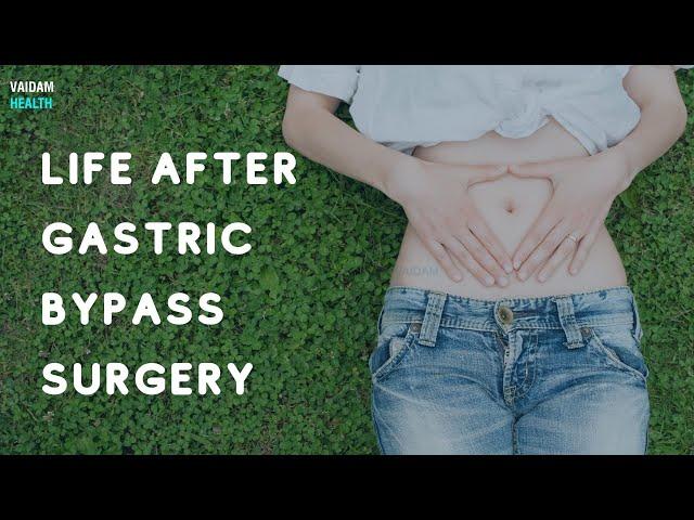 Life After Gastric Bypass Surgery