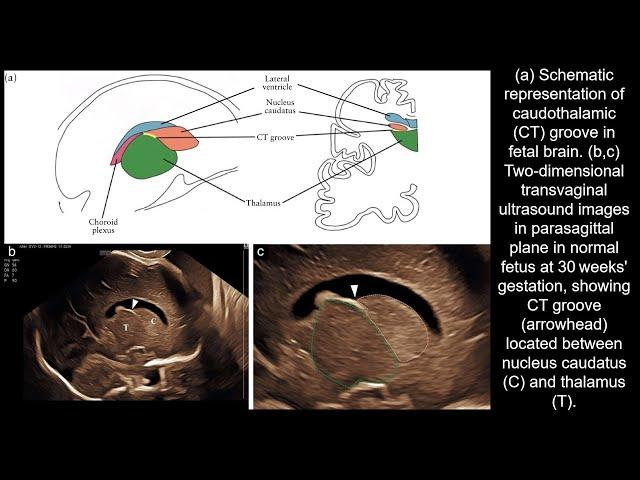 Visualization of caudothalamic groove at expert fetal neurosonography