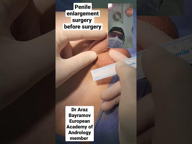 Penile enlargement surgery results before surgery Dr Araz Bayramov www.penilenlargement.com