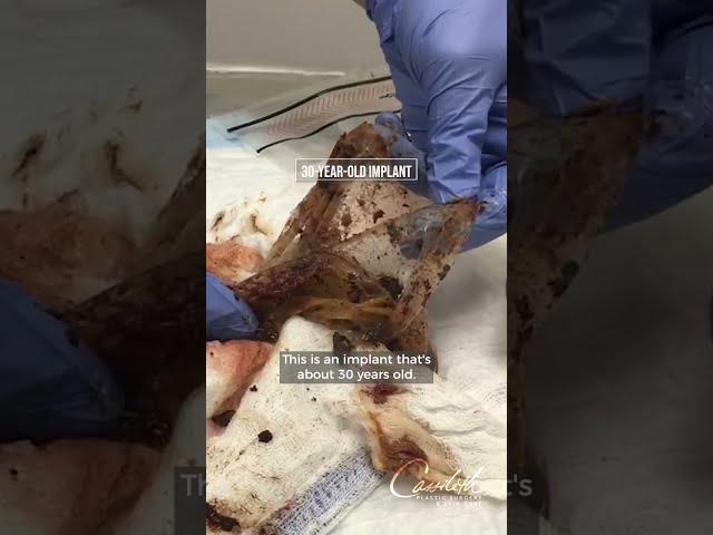 We Removed A 30-year-old Ruptured Breast Implant And This Is What We Found