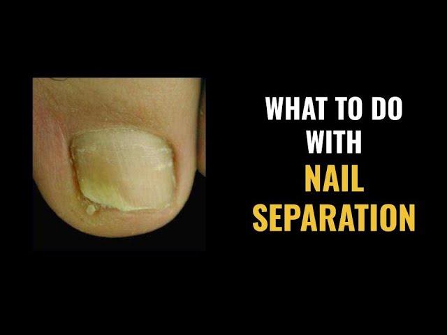 NAIL SEPARATION - What to DO and What are the CAUSES?