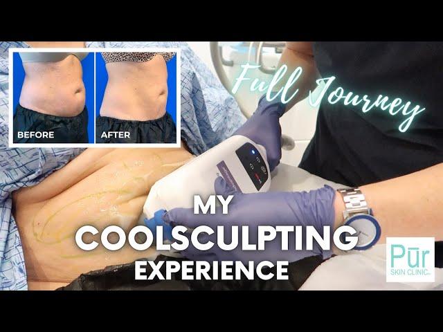 My COOLSCULPTING EXPERIENCE | Full Journey + COOLSCULPTING BEFORE AND AFTER Photos | Pūr Skin Clinic