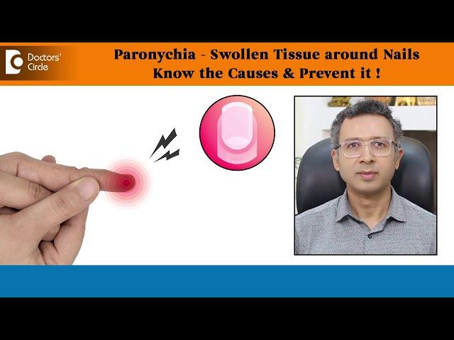 SWOLLEN TISSUE around Nails|PARONYCHIA-Causes, Prevention & Treatment-Dr.Nischal K C|Doctors' Circle