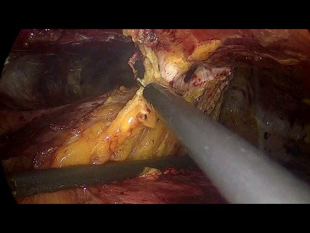 eTEP R-S Tips and Tricks, dissecting and suturing the anterior abdominal wall. Dr Hector Valenzuela
