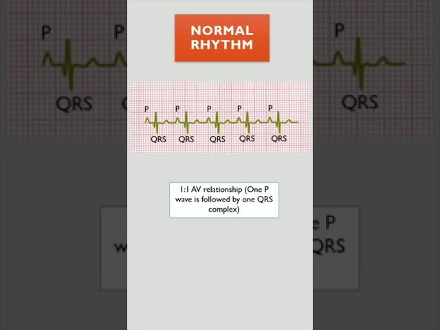 2:1 AV BLOCK || ECG COURSE || @LearningCardiology