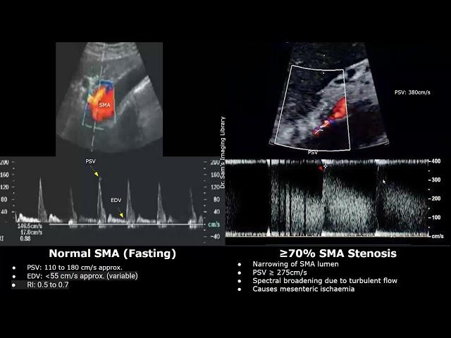 Superior Mesenteric Artery (SMA) Doppler Ultrasound Normal Vs Abnormal Images | Vascular USG Cases