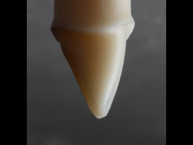 All Ceramic Crown Preparation for E.max and Zirconia