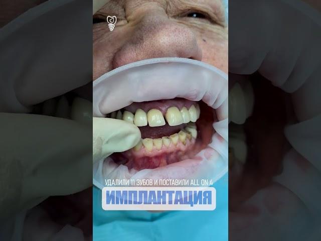 Удалили 11 зубов и поставили all on 4. 11 teeth removed and put all on 4.