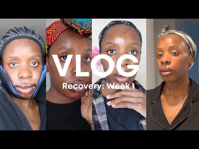 VLOG #13: Week 1 After Double Jaw Surgery - Nasal Congestion, Sleepless Nights & Balloon Swelling!