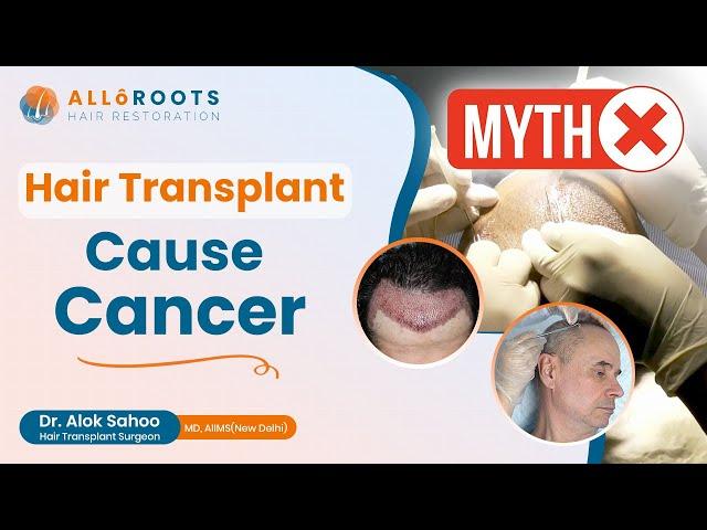 Do hair transplants cause cancer? | Dr. Alok Sahoo Busts the Myth