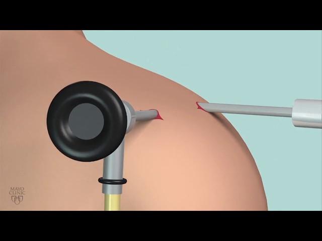 Removing excess bone near rotator cuff