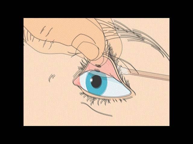 How to remove a foreign body from the eye