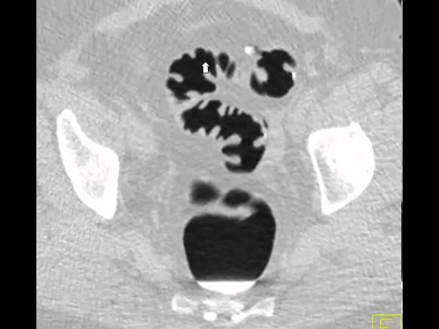 virtual colon: Stool impacted in diverticulum. CASE64A.avi