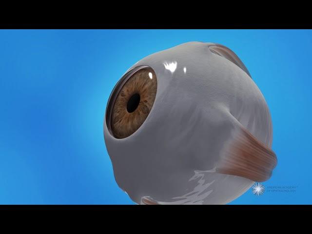 LASIK (Microkeratome)