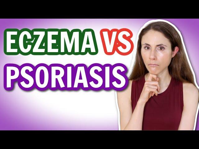 ECZEMA VS PSORIASIS: HOW TO TELL THE DIFFERENCE  @DrDrayzday