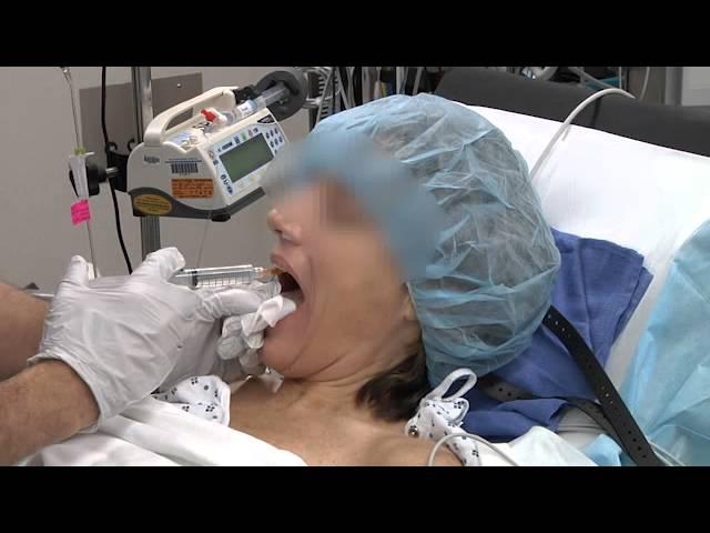 A technique of awake intubation from AOD