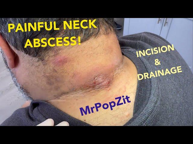 Painful neck abscess drained. 7 day follow up at end of video. Acid base shift, deep loculations.