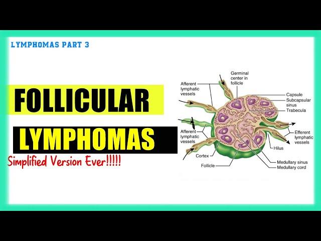 Follicular lymphoma | Lymphomas Made Easy | Speedy Medical