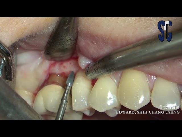 Restorative crown lengthening in root proximity