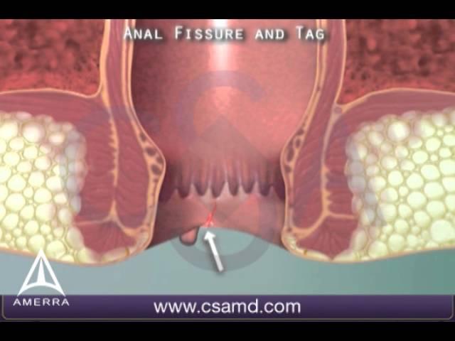 What is an anal fissure? 3D animation