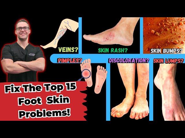 Top 15 Foot Skin Problems [Toenail Fungus, Dry Skin & More]