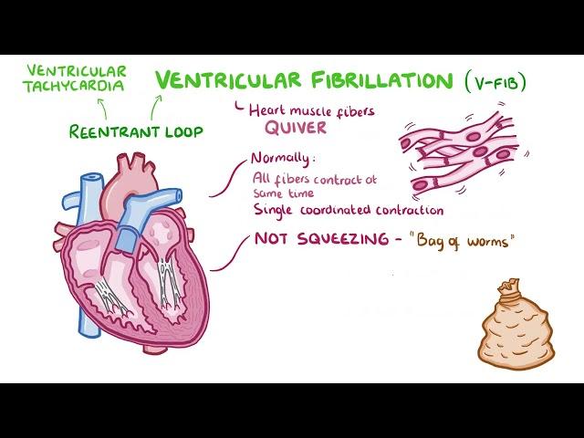 Brugada Syndrome | Osmosis