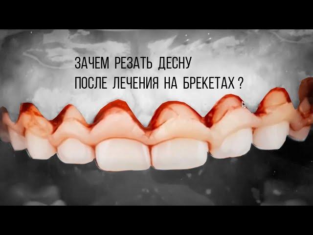 Отрежем десну [после ношения брекетов‼️], и всё, будут красивые зубы