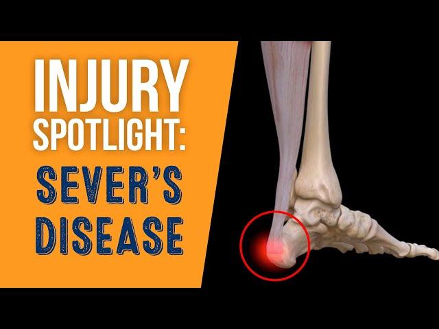 What is Sever's Disease (Calcaneal Apophysitis)?