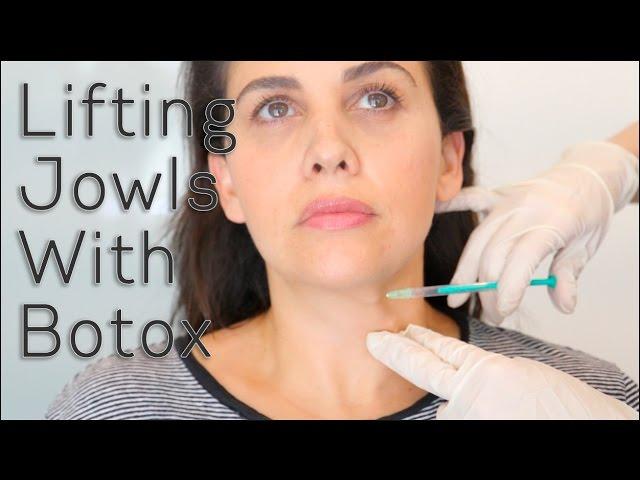 Lifting Jowls With Botox | BLUSH Beverly Hills