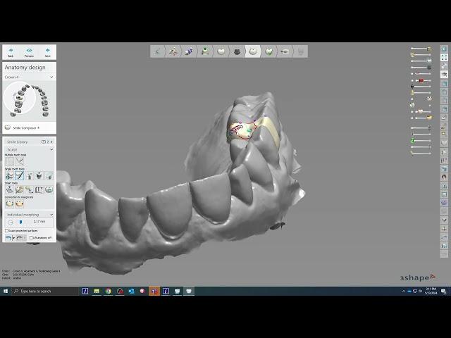 AnatotempSC - 3Shape Custom Abutment Design