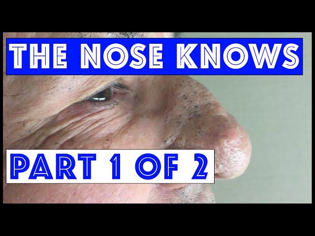 The Nose Knows: Part I "Mr. Wilson's" Blackhead Extractions