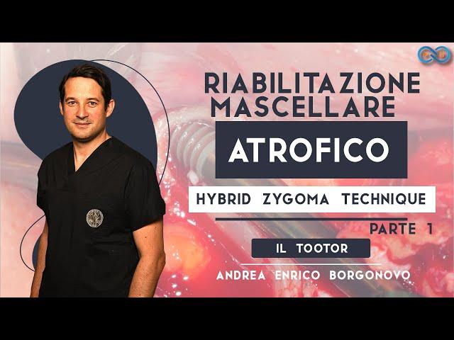 Riabilitazione mascellare atrofico con Hybrid Zygoma technique