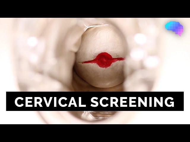 Cervical Screening (SMEAR) - OSCE Guide | UKMLA | CPSA