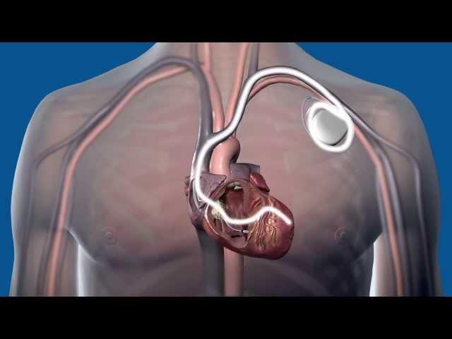 What is Cardiac Resynchronization Therapy CRT, and how does it work?